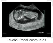 Nuchal Translucency in 2D