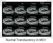Nuchal Translucency in MSV