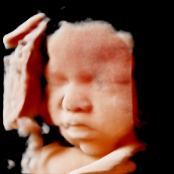 Magzat arcáról készült valósághű 3d ultrahang kép