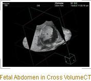 3DXI Volume CT ultrahang képalkotási technika