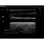 EKO7 vascularis ultrahang kép