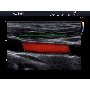 Cardiovascularis ultrahang Carotis képe - Accuvix 