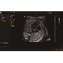 Magzati szív vizsgálata (fetal echo)